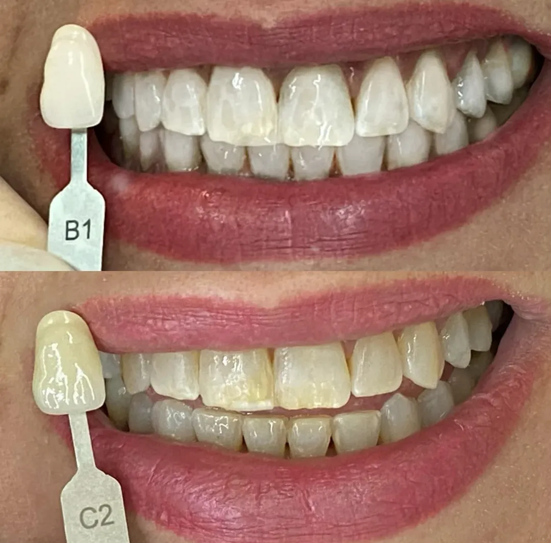 Antes e Depois 1