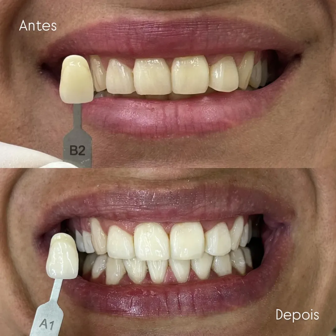 Antes e Depois 2