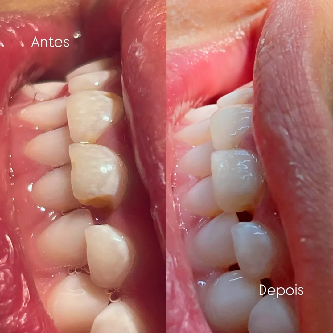 Antes e Depois 4