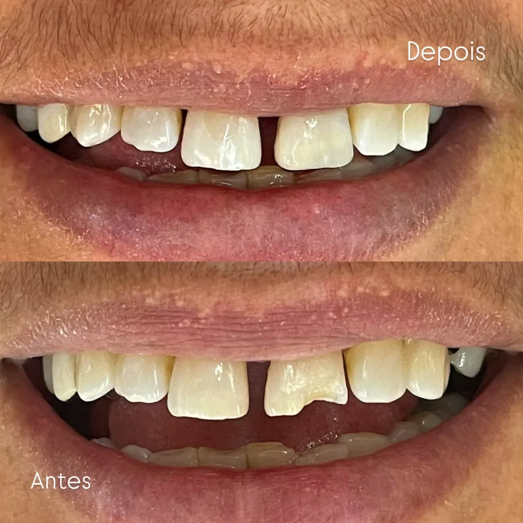 Antes e Depois 5