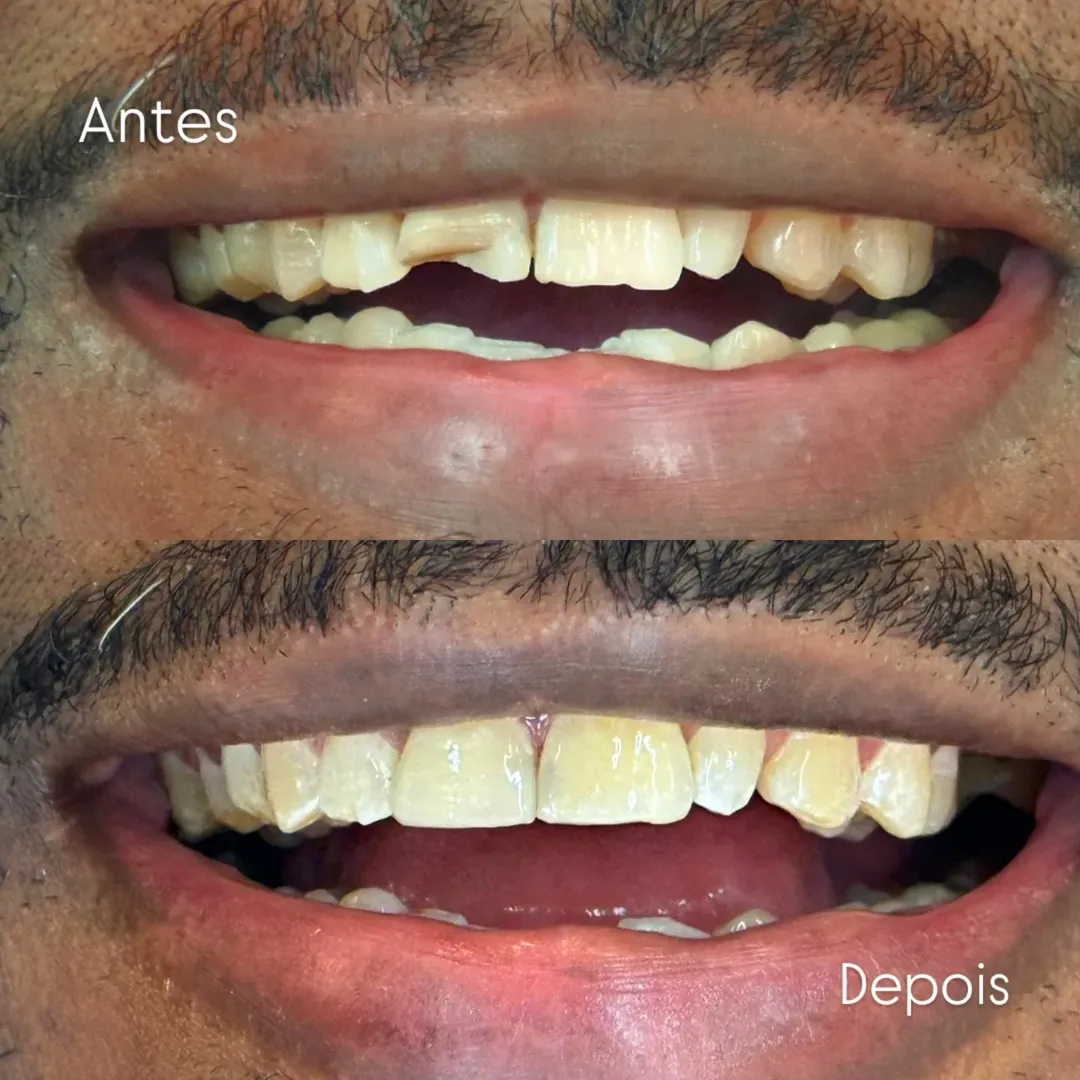 Antes e Depois 6